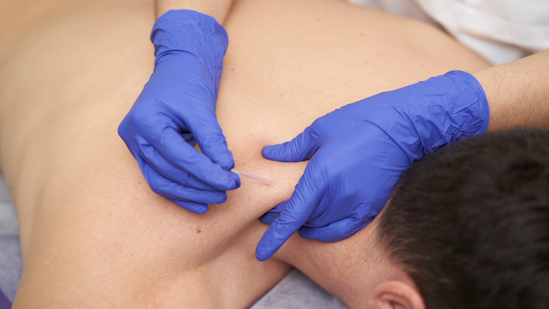 Dry Needling: Terapi untuk Membantu Mengatasi Nyeri dan Ketegangan Otot